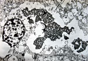 M,71y. | Alzheimer diseaseaccompanied with CADASIL - hyaline body in astrocyte M,71y. | Alzheimer diseaseaccompanied with CADASIL - hyaline body in astrocyte